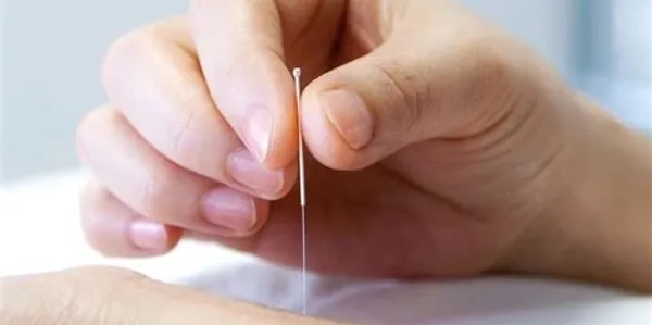 Acupuncture