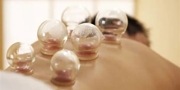cupping